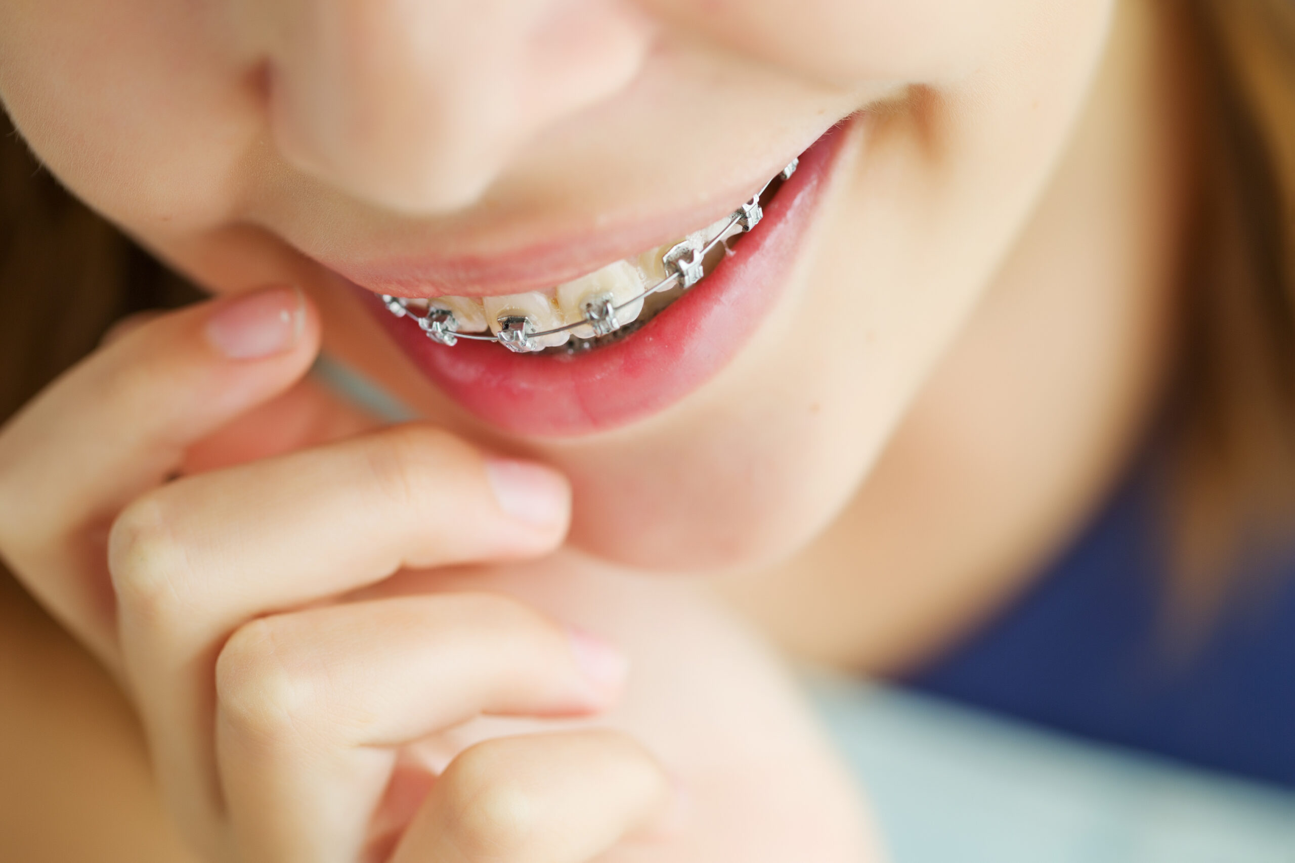 Damon braces
