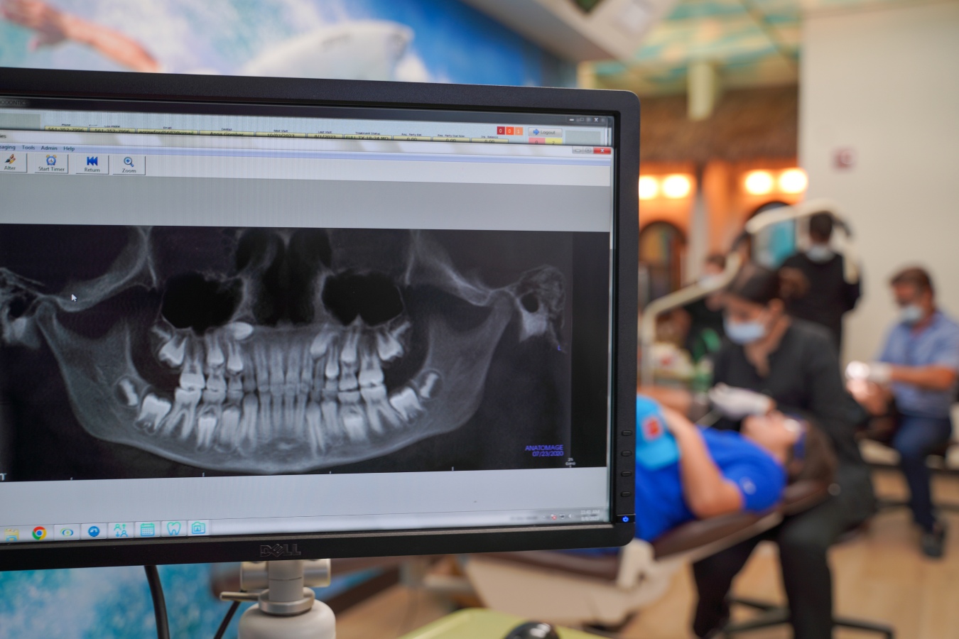 Invisalign Mandibular Advancement